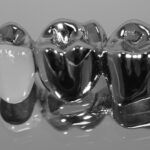 brücke nem vollguss + teilverble