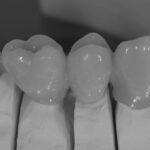 brücke nem vollverblendet dsf