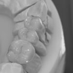 brücke zirkon vollverblendet d