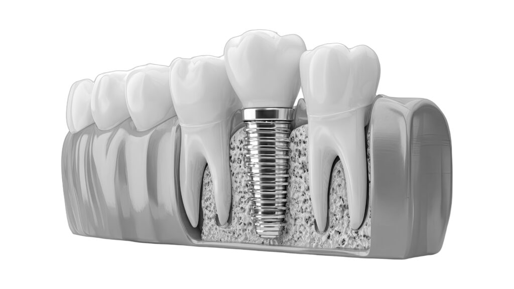 implantat grafik canva 1