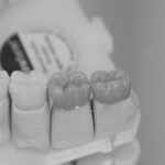 kronen nem vollverblendet 1 ds