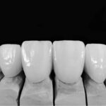 kronen zirkon canva 4